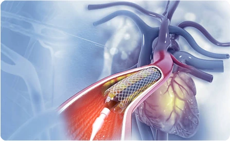 Cardiology Treatment in Malaysia