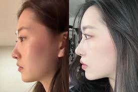 Cosmetic Surgery in South Korea