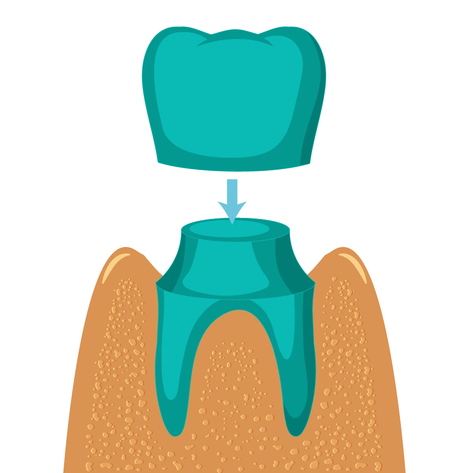 Dental-Crown