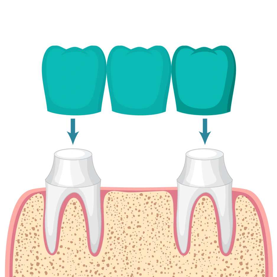 Dental-Bridge