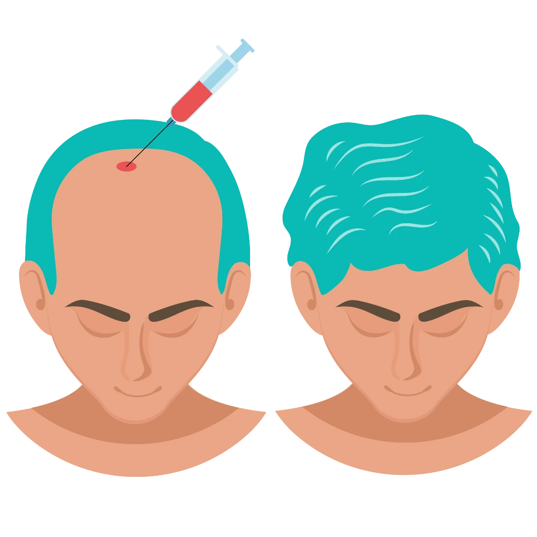 Stem-Cell-Hair-Transplant