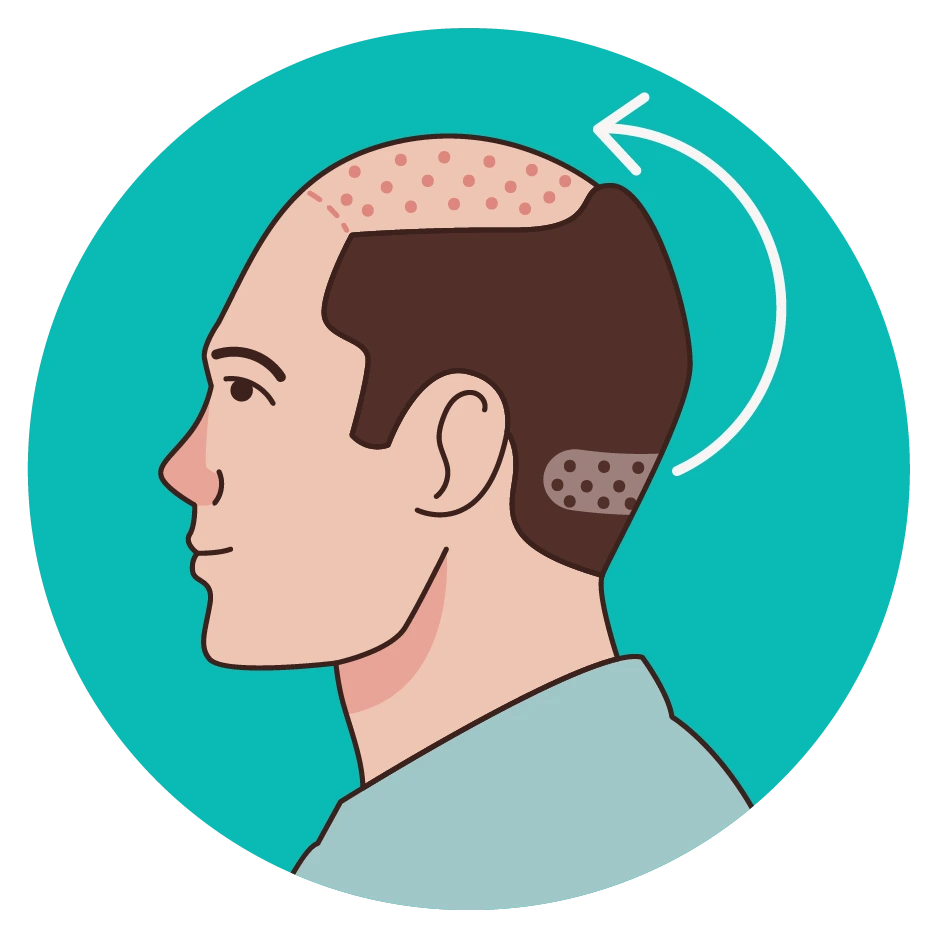 Follicular-Unit-Transplant