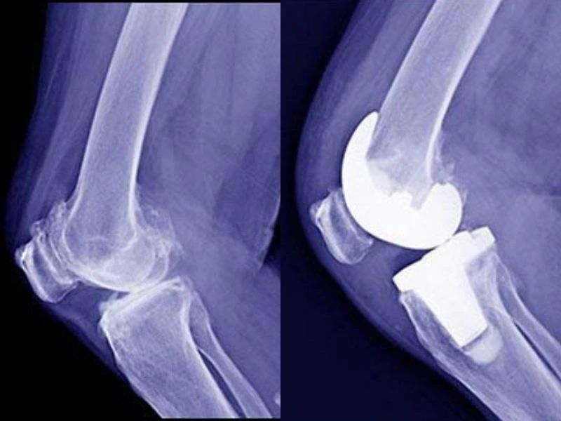 Knee Replacement Mexico